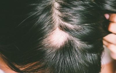 Alopecia Areata: Causes, Symptoms, Management and Clinical Features