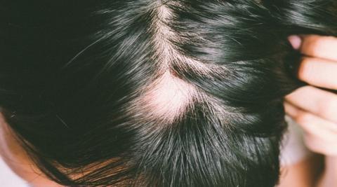 Alopecia Areata (Symptoms, Causes, Types, Treatment, and 