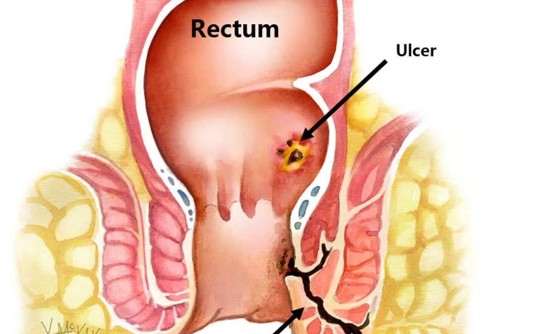 Ayurvedic Treatment Of Fistula In Ano Through Ksharsurta