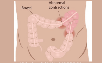 AYURVEDIC MANAGEMENT OF IRRITABLE BOWEL SYNDROME (IBS)